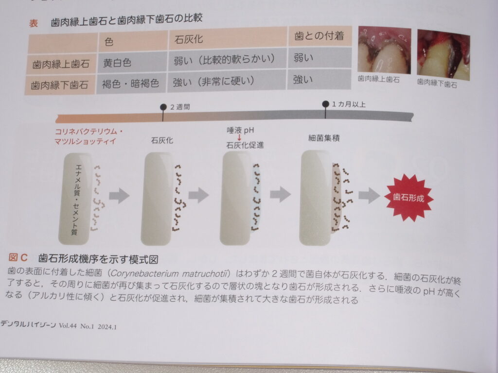 Q 歯石はどのように」作られるのでしょうか？ – 徳島問屋町KT歯科