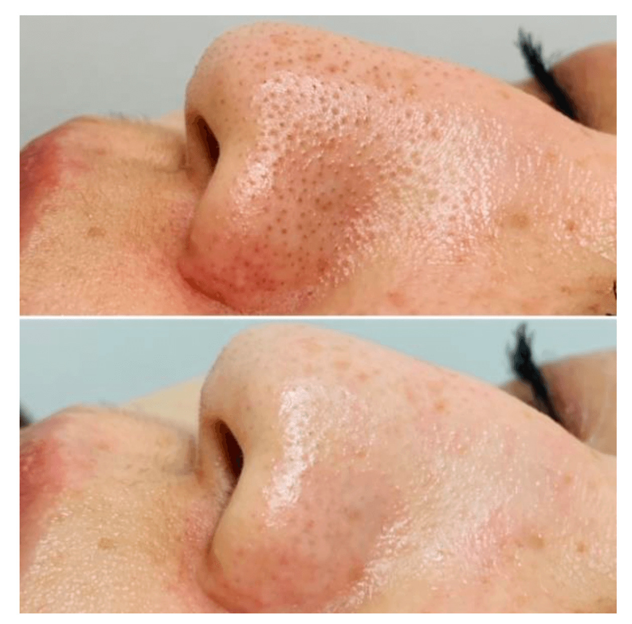 ハイドラジェントル - 秋田市の美容皮膚科 AdeBクリニック