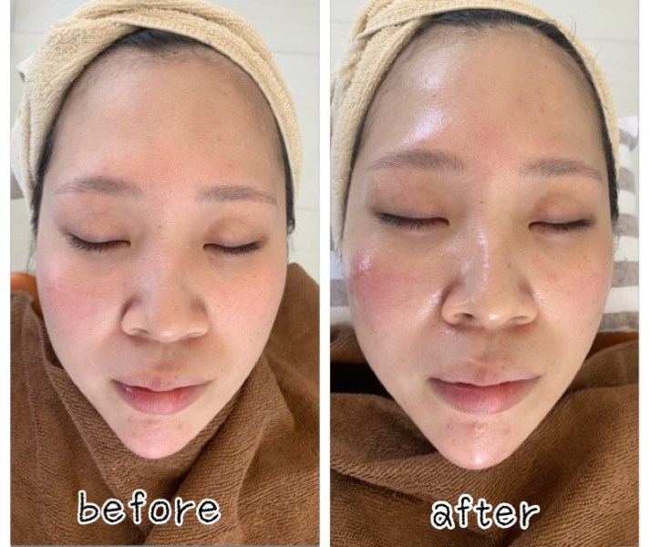 マッサージピール | 恵比寿の美容外科・美容皮膚科・ハイフ・シミ取り