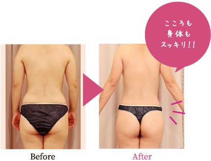 細胞レベルの痩身ダイエット進化した脂肪溶解スペシャルトリートメント