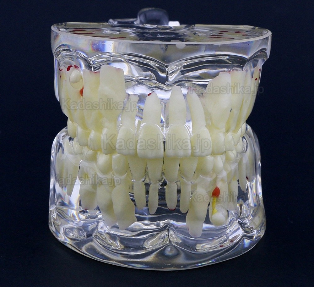 透明乳歯疾患模型 子供小児歯科病理模型 #4002 - 荷田歯科(kadashika.jp)