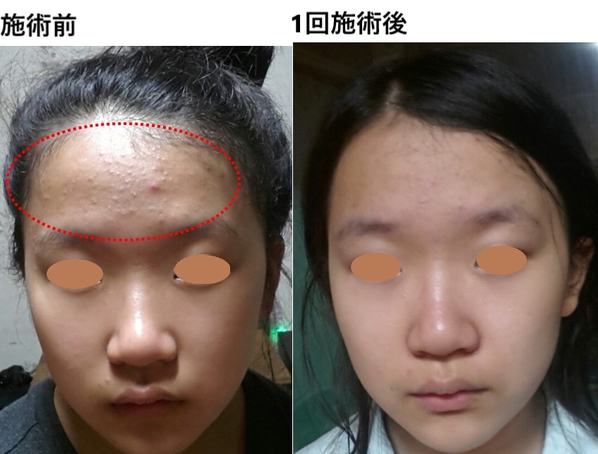 プラズマシャワープラズマフェイシャル