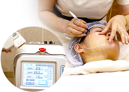 高密度焦点式超音波リフト（HIFU）でたるみ治療｜東京・銀座肌クリニック