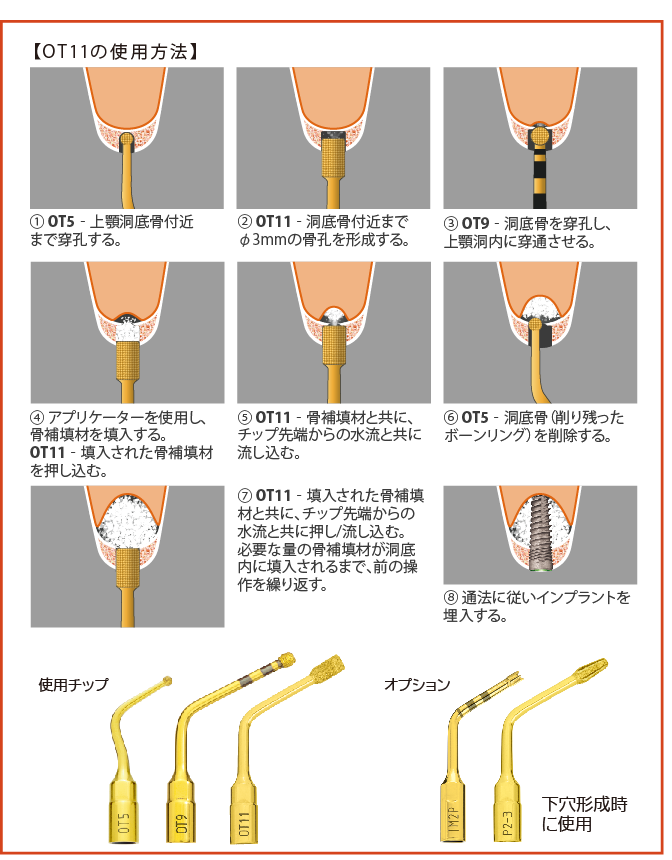 インサートチップOT11｜株式会社インプラテックスの取扱い商品