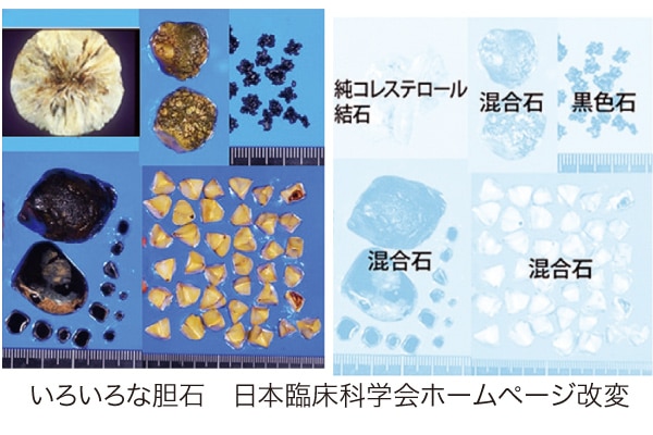 胆石症 ｜ 病気ピックアップ｜ JA新潟厚生連
