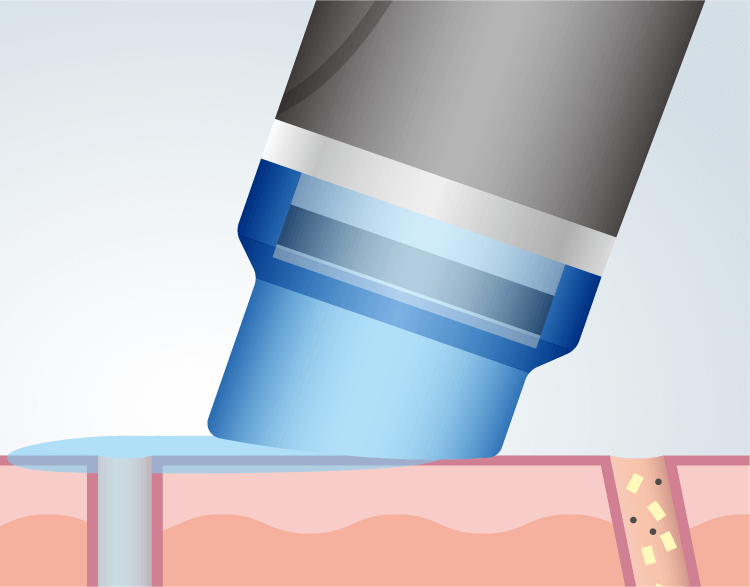ハイドラフェイシャル【公式】にしたんクリニック
