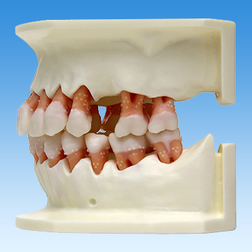 歯周病学基礎実習用顎模型(歯槽歯肉クリアピンク色・D咬合器つき