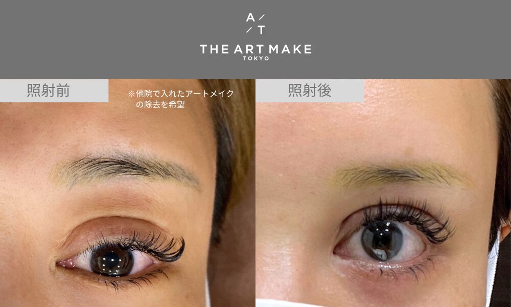 アートメイク色素を徹底解説！基礎から色選びに失敗したときの対処法