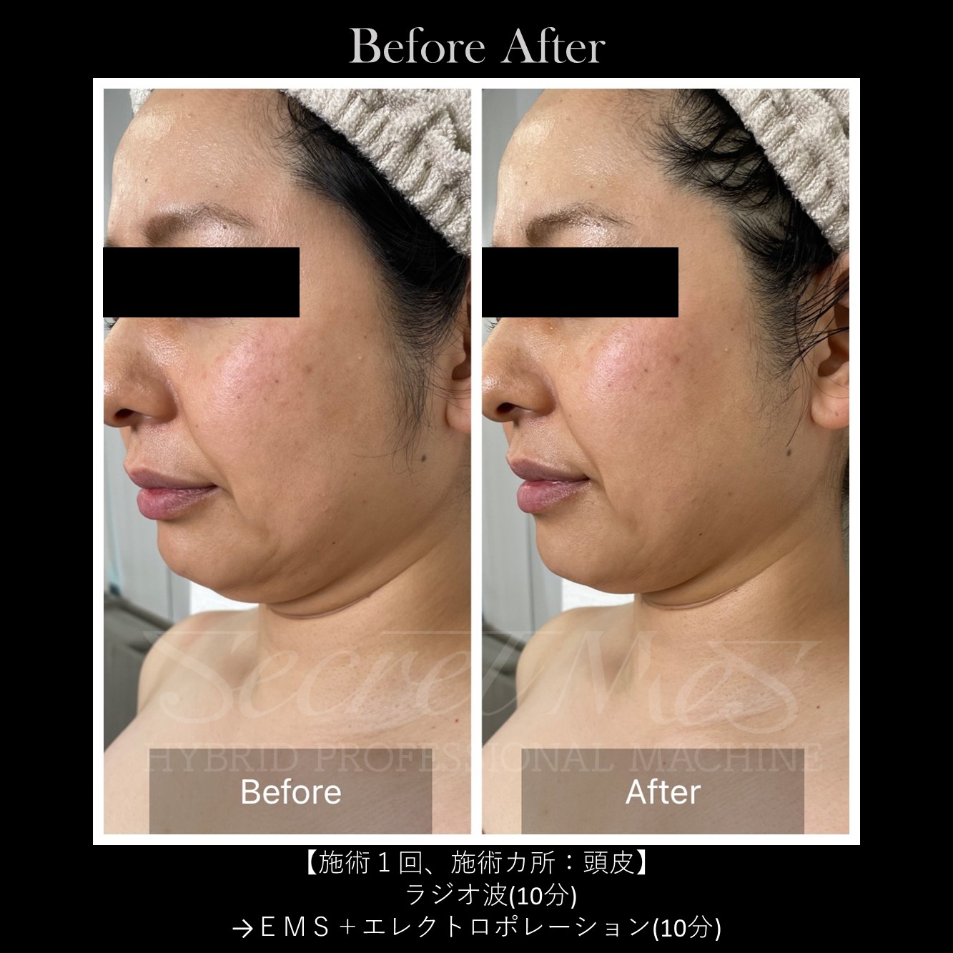 サーマフラクショナル リフトアップ サーマクール 高周波 ラジオ波