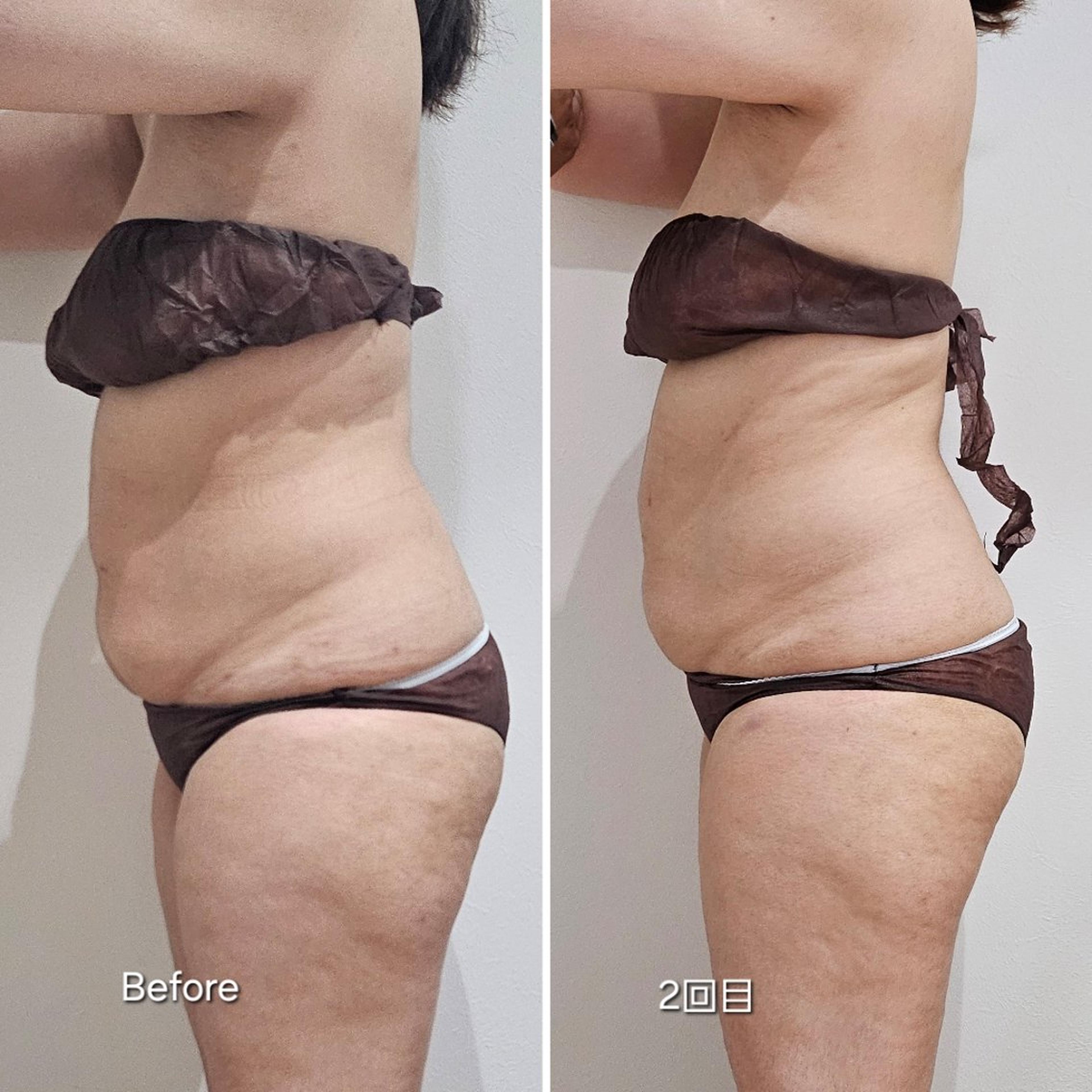 脂肪冷却 クーリング 2カップ 上下腹部2カップの Before→Afterのお写真