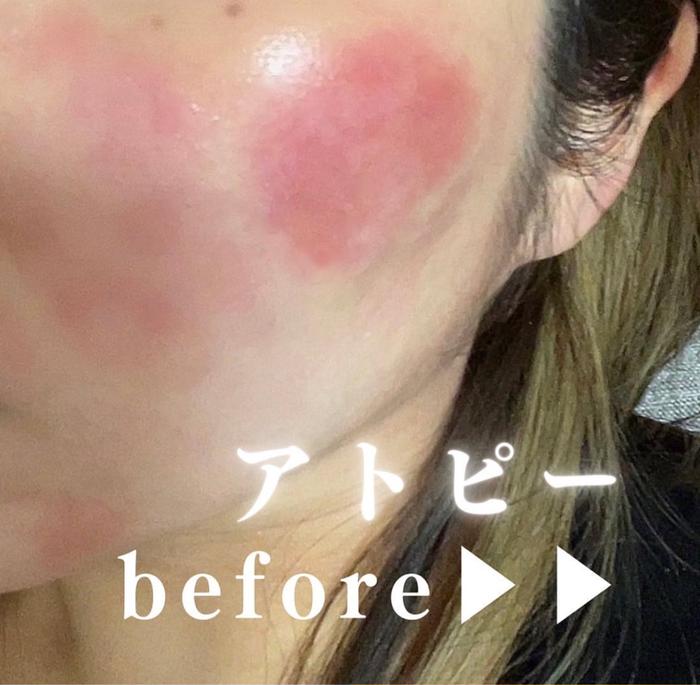 プラズマペン繰り返すニキビ肌に肌荒れに業務用・セルフok