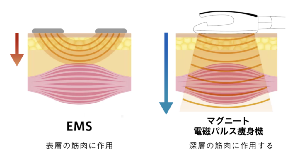 電磁パルスems 骨盤底筋マグニート