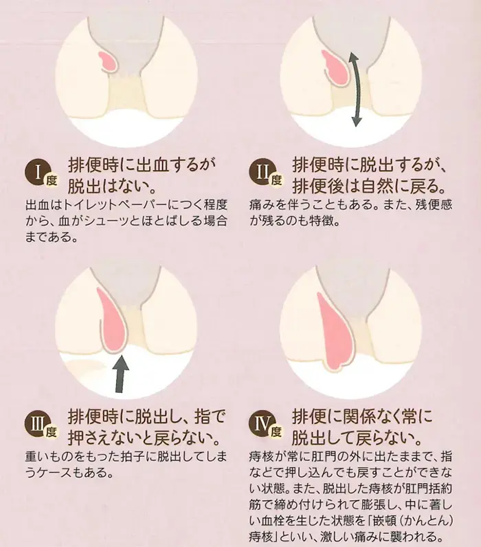 切れ痔（裂肛） | はたクリニック