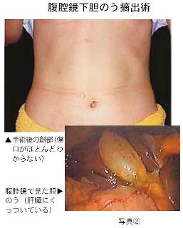 胆のうの中にあった石