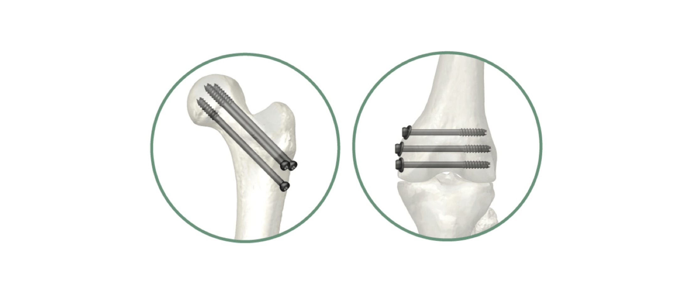 骨折様 VP9 大腿骨頚部適応インプラント｜製品情報｜株式会社 ホムズ技研