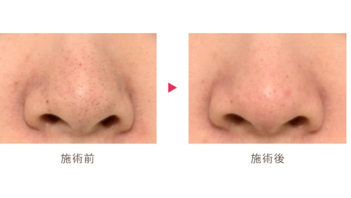 ハイドラフェイシャル（1回） | 八事石坂クリニック 八事院