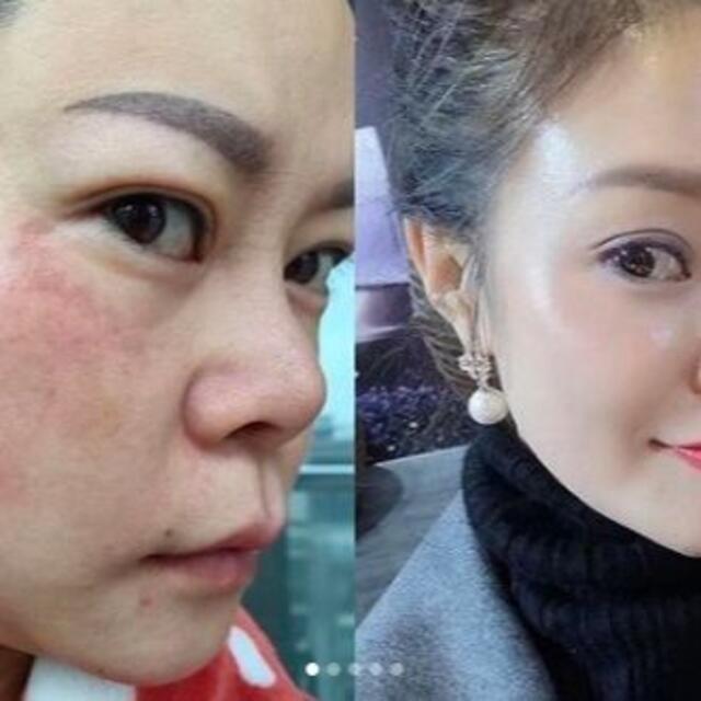 ☆正規品☆ルネセル ReneCell ダイヤモンドピール 水光肌 整形コスメ