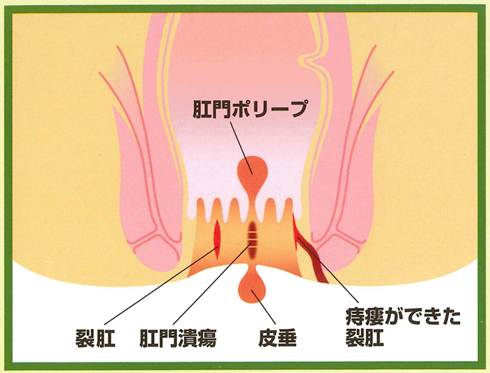 切れ痔（裂肛） | 北村医院