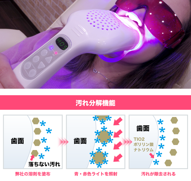 KOBEホワイトニングのセルフホワイトニング┃KOBEホワイトニング株式会社