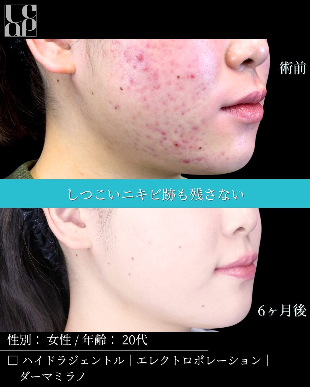 ケミカルピーリング＋エレクトロポレーション7回 - 栃木県 宇都宮駅