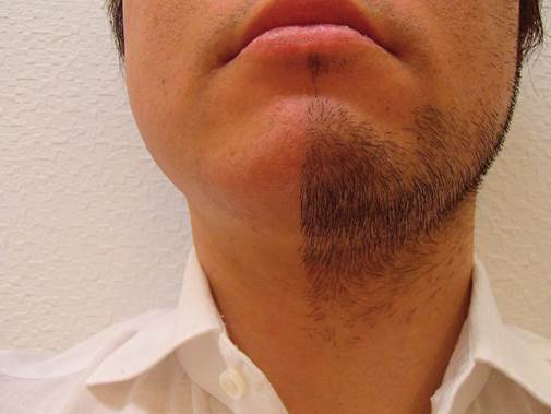 BeforeAfter│神戸三宮の男性専門メンズ脱毛 LOZEL HOMME(ロゼル オム