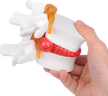 Amazon.co.jp: Romantic桜 脊椎模型 椎間板ヘルニアモデル 1:1.5サイズ