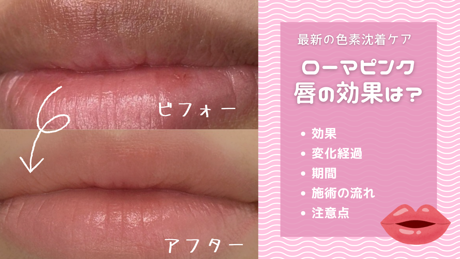 romapink ローマピンク アフタークリーム 唇 ローマピンク公式販売店