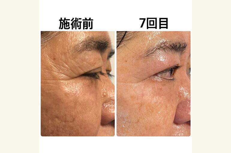 プラズマシャワープラズマフェイシャル